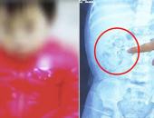 Hai bên thận của bé 9 tháng tuổi chứa đầy sỏi, biết nguyên nhân mẹ bật khóc hối hận Hai bên thận của bé 9 tháng tuổi chứa đầy sỏi, biết nguyên nhân mẹ bật khóc hối hận