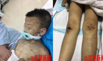 Đến thăm con, mẹ chết lặng khi phát hiện con trai bị vợ hai của chồng đánh đập thậm tệ Đến thăm con, mẹ chết lặng khi phát hiện con trai bị vợ hai của chồng đánh đập thậm tệ