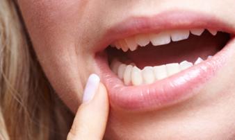 Dấu hiệu không ngờ cảnh báo bạn đang mắc ung thư miệng, cần tới bệnh viện ngay Dấu hiệu không ngờ cảnh báo bạn đang mắc ung thư miệng, cần tới bệnh viện ngay