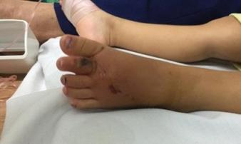 Trẻ nhỏ liên tiếp nhập viện vì bị rắn độc cắn, nhiều ca nặng có dấu hiệu hoại tử Trẻ nhỏ liên tiếp nhập viện vì bị rắn độc cắn, nhiều ca nặng có dấu hiệu hoại tử
