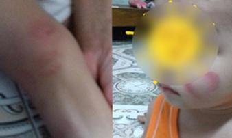 Hà Nam: Phụ huynh 'tố' giáo viên mầm non bỏ lớp khiến các cháu cào nhau rách mặt Hà Nam: Phụ huynh 'tố' giáo viên mầm non bỏ lớp khiến các cháu cào nhau rách mặt