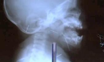 Tá hỏa phát hiện 10 cây kim trong cơ thể bé trai 9 tháng tuổi Tá hỏa phát hiện 10 cây kim trong cơ thể bé trai 9 tháng tuổi