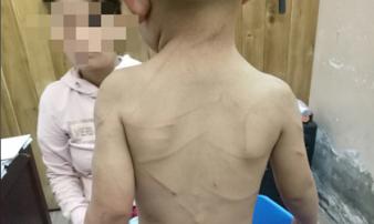 Giải cứu bé trai 3 tuổi bị cha dượng đánh dã man ở Phú Quốc Giải cứu bé trai 3 tuổi bị cha dượng đánh dã man ở Phú Quốc