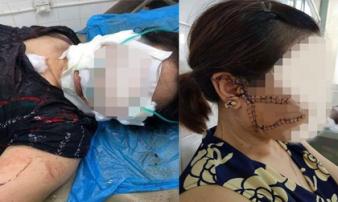 Người phụ nữ tố bị chồng ghen tuông cắt đứt 3 gân chân, rạch mặt Người phụ nữ tố bị chồng ghen tuông cắt đứt 3 gân chân, rạch mặt