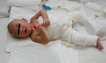 Cậu bé bị bỏng nước sôi 100 độ, hành động sơ cứu của người mẹ ai cũng nên học hỏi Cậu bé bị bỏng nước sôi 100 độ, hành động sơ cứu của người mẹ ai cũng nên học hỏi