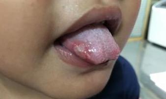 Mắc tay chân miệng, bé càng đau càng dễ biến chứng, cha mẹ cẩn thận khi con loét miệng Mắc tay chân miệng, bé càng đau càng dễ biến chứng, cha mẹ cẩn thận khi con loét miệng