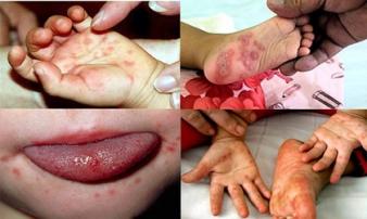 Dịch tay chân miệng: Lại thêm trẻ tử vong - cha mẹ cần làm điều này ngay khi con bệnh để cứu bé Dịch tay chân miệng: Lại thêm trẻ tử vong - cha mẹ cần làm điều này ngay khi con bệnh để cứu bé