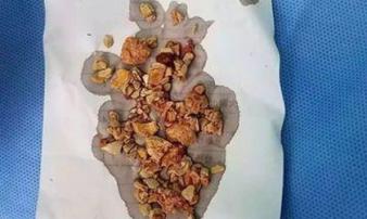 Thận đứa trẻ 5 tháng tuổi chứa đầy sỏi, vì cha mẹ cho ăn theo cách tai hại Thận đứa trẻ 5 tháng tuổi chứa đầy sỏi, vì cha mẹ cho ăn theo cách tai hại