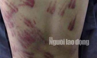 Bé trai 10 tuổi bị sư thầy bạo hành thâm tím khắp người Bé trai 10 tuổi bị sư thầy bạo hành thâm tím khắp người