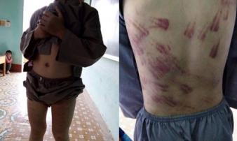 Sư thầy bạo hành bé trai 10 tuổi thâm tím khắp người lên tiếng Sư thầy bạo hành bé trai 10 tuổi thâm tím khắp người lên tiếng