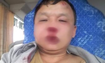 Sau tin nhắn của ông chủ, tài xế xe khách bị côn đồ chặn đánh bầm dập Sau tin nhắn của ông chủ, tài xế xe khách bị côn đồ chặn đánh bầm dập