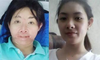 Sau 700 ngày bị chồng tẩm xăng đốt, người mẹ từng rất xinh đẹp đếm ngược để được gặp con Sau 700 ngày bị chồng tẩm xăng đốt, người mẹ từng rất xinh đẹp đếm ngược để được gặp con