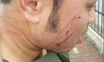 Đề nghị khởi tố ‘cò’ taxi đánh nhân viên sân bay Nội Bài gãy răng Đề nghị khởi tố ‘cò’ taxi đánh nhân viên sân bay Nội Bài gãy răng