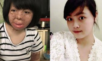 Người vợ xinh đẹp bị chồng đốt ngày mùng 2 Tết giờ ra sao? Người vợ xinh đẹp bị chồng đốt ngày mùng 2 Tết giờ ra sao?