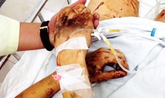 Vụ Việt kiều bị tạt axit, cắt gân chân: Hai người đàn ông đè người Tom xuống và cắt 3 nhát Vụ Việt kiều bị tạt axit, cắt gân chân: Hai người đàn ông đè người Tom xuống và cắt 3 nhát