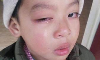 Lạng Sơn: Bé trai có nguy cơ mù vì bị cô giáo chủ nhiệm dùng thước đánh vào mắt Lạng Sơn: Bé trai có nguy cơ mù vì bị cô giáo chủ nhiệm dùng thước đánh vào mắt