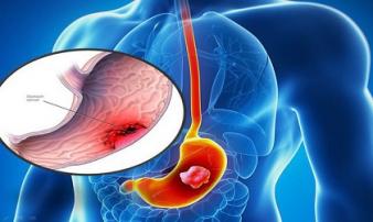 5 anh em nhưng 4 người bị ung thư dạ dày, 'sát thủ' ở ngay trong chính bữa ăn 5 anh em nhưng 4 người bị ung thư dạ dày, 'sát thủ' ở ngay trong chính bữa ăn