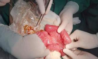 Bé trai 3 tuổi nôn ra cả búi giun, bác sĩ khuyên đừng để mắc bệnh vì tiếc 20.000 đồng Bé trai 3 tuổi nôn ra cả búi giun, bác sĩ khuyên đừng để mắc bệnh vì tiếc 20.000 đồng