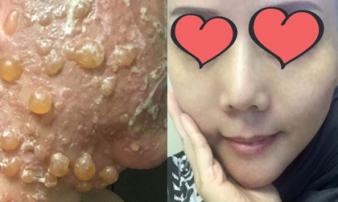 'Phẫu thuật' căng da mặt khiến cả khuôn mặt người phụ nữ bị bao phủ trong những vết phồng rộp kinh hoàng 'Phẫu thuật' căng da mặt khiến cả khuôn mặt người phụ nữ bị bao phủ trong những vết phồng rộp kinh hoàng