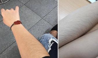 Rậm lông, rụng tóc coi chừng dấu hiệu cảnh báo căn bệnh gây vô sinh Rậm lông, rụng tóc coi chừng dấu hiệu cảnh báo căn bệnh gây vô sinh