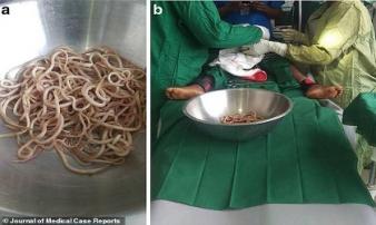 Bé trai 4 tuổi táo bón 6 tháng, bác sĩ phẫu thuật “tá hoả” khi thấy thứ trong bụng bé Bé trai 4 tuổi táo bón 6 tháng, bác sĩ phẫu thuật “tá hoả” khi thấy thứ trong bụng bé