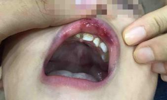 Mẹ phát hiện con 3 tuổi bị cô giáo đánh bầm dập, tụ máu mồm chỉ vì lý do này Mẹ phát hiện con 3 tuổi bị cô giáo đánh bầm dập, tụ máu mồm chỉ vì lý do này