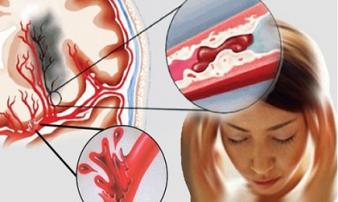 5 dấu hiệu cảnh báo chứng tắc mạch máu, đề phòng tử thần gõ cửa, nguy hiểm nhất là số 1 5 dấu hiệu cảnh báo chứng tắc mạch máu, đề phòng tử thần gõ cửa, nguy hiểm nhất là số 1