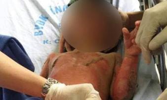 Vụ cô giáo đốt cồn dạy cháy nổ, 3 trẻ bị bỏng tiên lượng xấu Vụ cô giáo đốt cồn dạy cháy nổ, 3 trẻ bị bỏng tiên lượng xấu