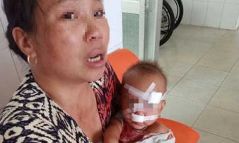 Mẹ bé gái bị cha ruột ném ly vào mặt, khâu 12 mũi: 'Lúc 13 tháng, con bé cũng bị ném vật cứng làm chấn thương sọ não' Mẹ bé gái bị cha ruột ném ly vào mặt, khâu 12 mũi: 'Lúc 13 tháng, con bé cũng bị ném vật cứng làm chấn thương sọ não'