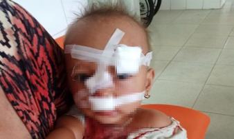 Bố mẹ cãi nhau, bé gái 2 tuổi nhập viện, khâu 12 mũi trên mặt Bố mẹ cãi nhau, bé gái 2 tuổi nhập viện, khâu 12 mũi trên mặt