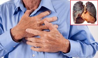 5 dấu hiệu chứng tỏ ung thư phổi đã 'tấn công' cơ thể, nhanh chân đi khám ngay 5 dấu hiệu chứng tỏ ung thư phổi đã 'tấn công' cơ thể, nhanh chân đi khám ngay