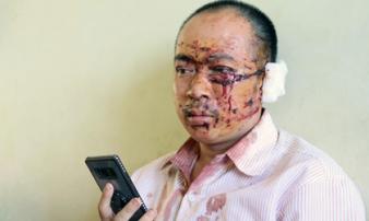Nạn nhân xe Phương Trang: Ai cũng la hét, người văng khắp nơi Nạn nhân xe Phương Trang: Ai cũng la hét, người văng khắp nơi