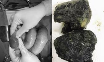 Thường xuyên uống trà sữa, nam thanh niên Phú Thọ phải cấp cứu vì tắc ruột Thường xuyên uống trà sữa, nam thanh niên Phú Thọ phải cấp cứu vì tắc ruột