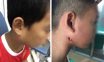 Một bệnh viện ở Nghệ An công bố 3 trẻ nhiễm bệnh Whitmore 'ăn thịt người': Cảnh báo dấu hiệu dễ nhầm lẫn với bệnh quai bị Một bệnh viện ở Nghệ An công bố 3 trẻ nhiễm bệnh Whitmore 'ăn thịt người': Cảnh báo dấu hiệu dễ nhầm lẫn với bệnh quai bị
