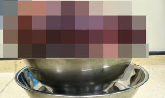 Kinh hoàng bệnh nhân 24 tuổi có khối u 2,3kg: Bác sĩ cảnh báo những triệu chứng cần đi kiểm tra ngay Kinh hoàng bệnh nhân 24 tuổi có khối u 2,3kg: Bác sĩ cảnh báo những triệu chứng cần đi kiểm tra ngay