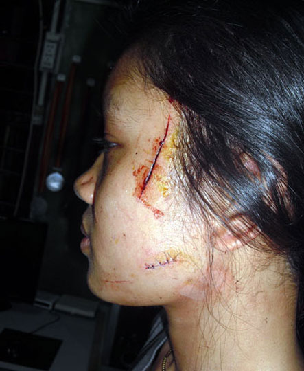 Em học sinh lớp 12 trường PTTH Trần Bình Trọng (thị xã Cam Đức, huyện Cam Lâm, tỉnh Khánh Hòa) bị rạch nhiều vết trên mặt. 