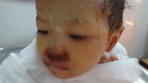 Bé 2 tuổi suýt chết vì đắp lá chữa bỏng - 1