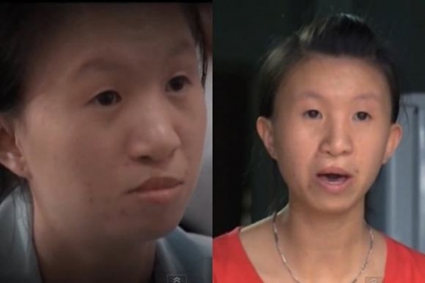 Sau phẫu thuật thẩm mỹ: Góc khuất của những cô gái Việt bỗng đẹp lên