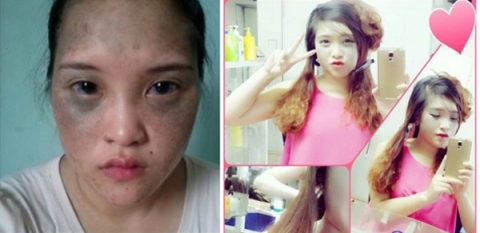 Ngỡ ngàng nhan sắc trước và sau phẫu thuật của 10 cô gái Việt
