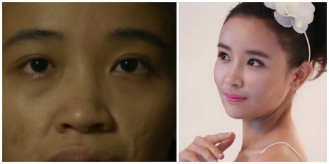 Khác lạ hình ảnh trước và sau phẫu thuật của 10 cô gái Việt