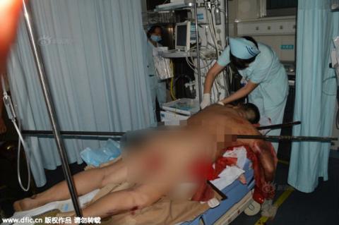 Kinh hoàng thanh dài gần 2m sắt xuyên qua người 0 Kinh hoàng thanh dài gần 2m sắt xuyên qua người 0