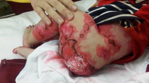 Thắt lòng tay chân bé trai 3 tháng tuổi bị lở loét ăn mòn gần hết - Ảnh 3