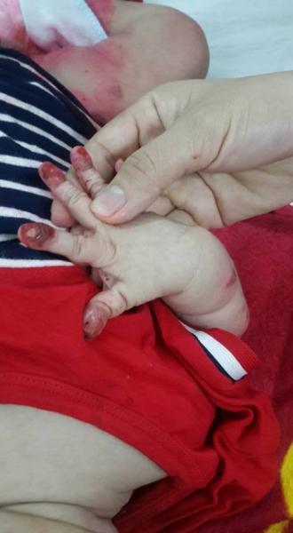 Thắt lòng tay chân bé trai 3 tháng tuổi bị lở loét ăn mòn gần hết - Ảnh 2