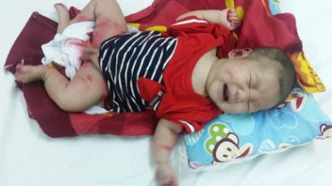 Thắt lòng tay chân bé trai 3 tháng tuổi bị lở loét ăn mòn gần hết - Ảnh 4