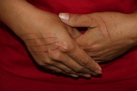 Vết rạch chị Vân bị bà Nhuần rạch