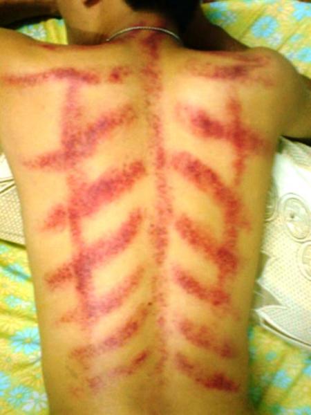 Tuyệt đối không được cạo gió cho bà bầu và trẻ em - 1