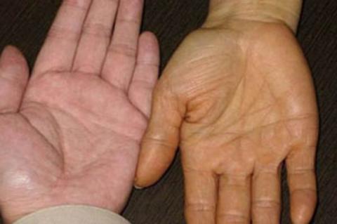 10 triệu chứng cảnh báo ung thư nguy hiểm nhưng dễ bị phớt lờ - 2