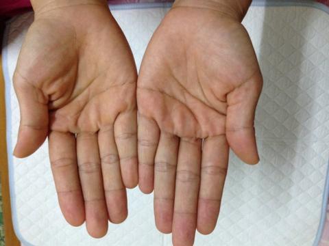 Khoi han benh nam an da tay sau 5 nam chua tri bang kem danh rang