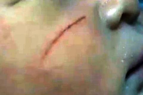 Bác sĩ sản khoa cắt cụt ngón tay trẻ sơ sinh khi mổ lấy thai - Ảnh 2.