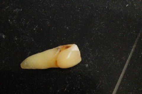 Vụ án hy hữu: Bị bắt vì rơi răng tại hiện trường - 2